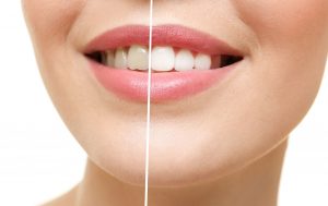 سفید کردن دندان تنها با خوردن ۴ خوراکی طبیعی و سالم